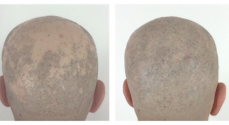 Alopecia areata: ¿qué es y cuál es la causa?