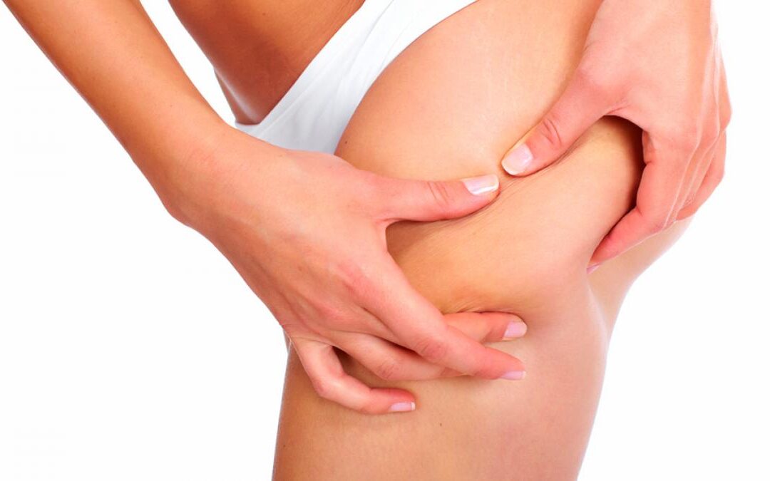 Celulitis: ¿problema estético o esconde alguna enfermedad?